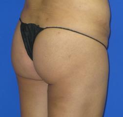 VASER Liposuction Before & After Patient #181