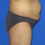 VASER Liposuction Before & After Patient #181