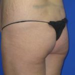 Liposuction Before & After Patient #229