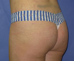 Liposuction Before & After Patient #229