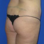 Liposuction Before & After Patient #229