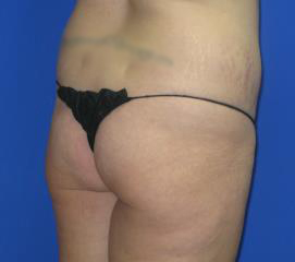 Liposuction Before & After Patient #229