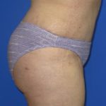 VASER Liposuction Before & After Patient #209
