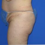 VASER Liposuction Before & After Patient #209