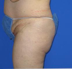 VASER Liposuction Before & After Patient #209