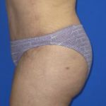 VASER Liposuction Before & After Patient #209