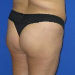 Brazilian Butt Lift Before & After Patient #189