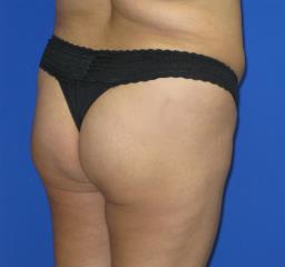 Brazilian Butt Lift Before & After Patient #189