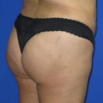 Brazilian Butt Lift Before & After Patient #189