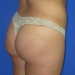 VASER Liposuction Before & After Patient #239