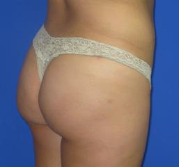 VASER Liposuction Before & After Patient #239