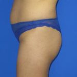 VASER Liposuction Before & After Patient #214