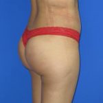 VASER Liposuction Before & After Patient #194