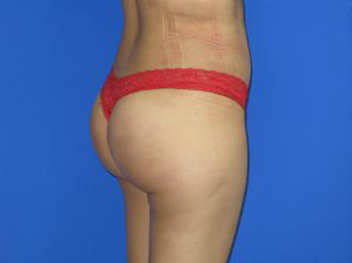 VASER Liposuction Before & After Patient #194