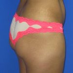Brazilian Butt Lift Before & After Patient #198