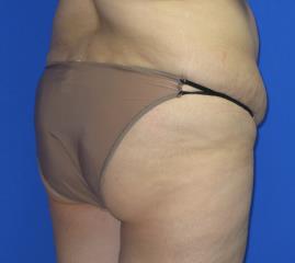 VASER Liposuction Before & After Patient #224