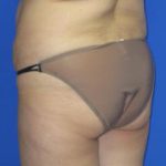 VASER Liposuction Before & After Patient #224