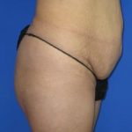 Liposuction Before & After Patient #219