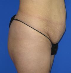 Liposuction Before & After Patient #219