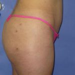 Liposuction Before & After Patient #219