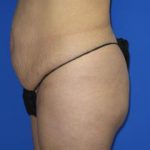 Liposuction Before & After Patient #219