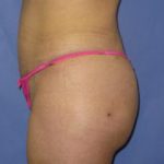 Liposuction Before & After Patient #219