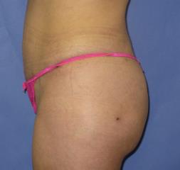 Liposuction Before & After Patient #219