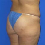 Liposuction Before & After Patient #204