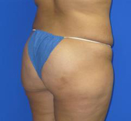 Liposuction Before & After Patient #204