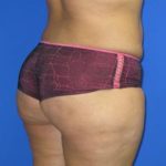 Liposuction Before & After Patient #204