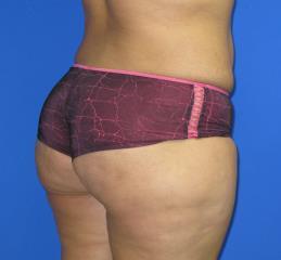 Liposuction Before & After Patient #204