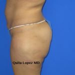 Liposuction Before & After Patient #204