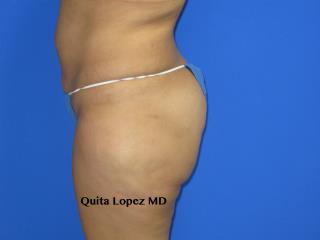 Liposuction Before & After Patient #204