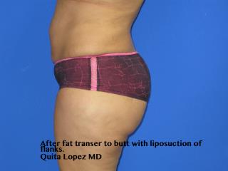Liposuction Before & After Patient #204