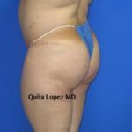 Liposuction Before & After Patient #235