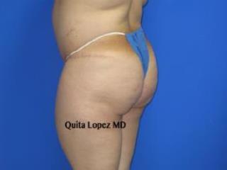 Liposuction Before & After Patient #235