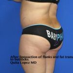 Liposuction Before & After Patient #235