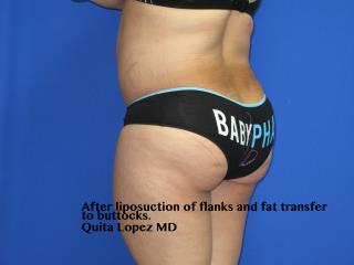 Liposuction Before & After Patient #235