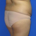 Liposuction Before & After Patient #244