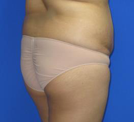 Liposuction Before & After Patient #244