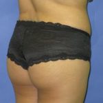 Liposuction Before & After Patient #244