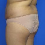 Liposuction Before & After Patient #244