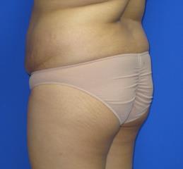 Liposuction Before & After Patient #244