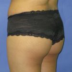 Liposuction Before & After Patient #244