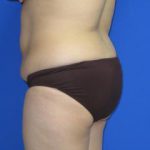 Liposuction Before & After Patient #250