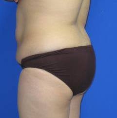 Liposuction Before & After Patient #250