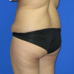 Liposuction Before & After Patient #253