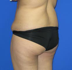 Liposuction Before & After Patient #253