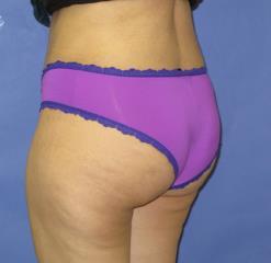 Liposuction Before & After Patient #253