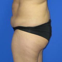 Liposuction Before & After Patient #253